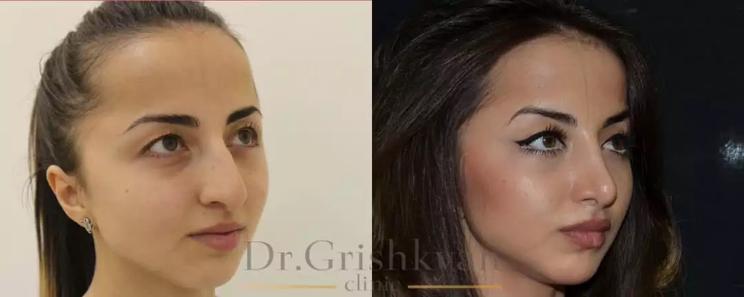 Ринопластика фото до и после. Фото с сайта Д.Р. Гришкяна. Имеются противопоказания, требуется консультация специалиста