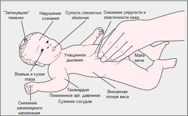 Лечение пищевых отравлений: что можно сделать в домашних условиях — клиника «Добробут»