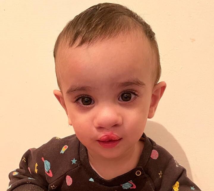 Абу-Бакр после первой операции - хейлоринопластики