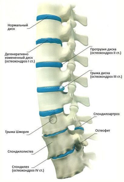 Особенности остеохондроза позвоночника