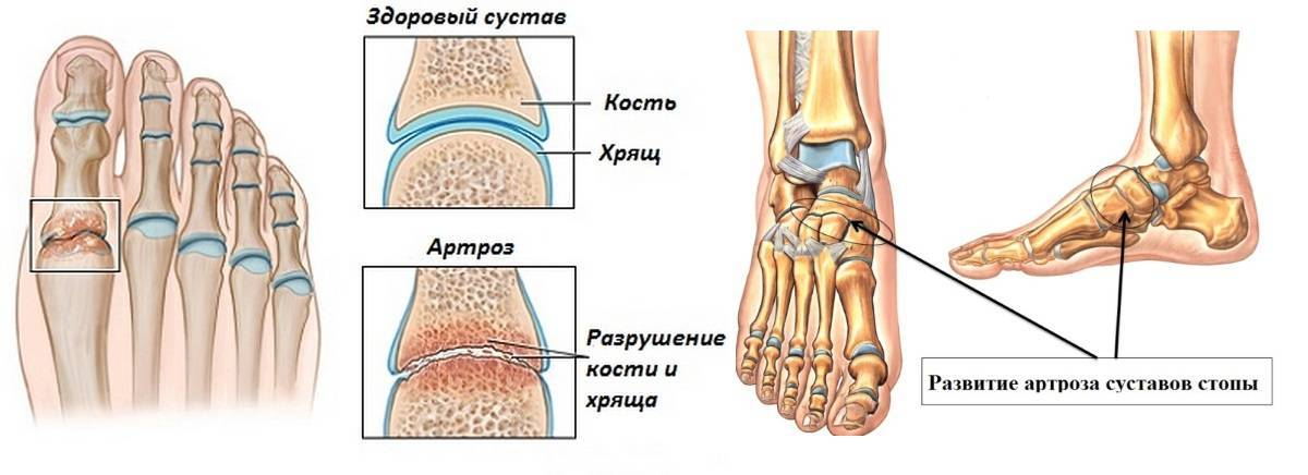 Хрустят кости. Артрит плюсневых суставов стопы. Артроз суставов предплюсны стопы. Остеоартроз суставов стопы 2ст.