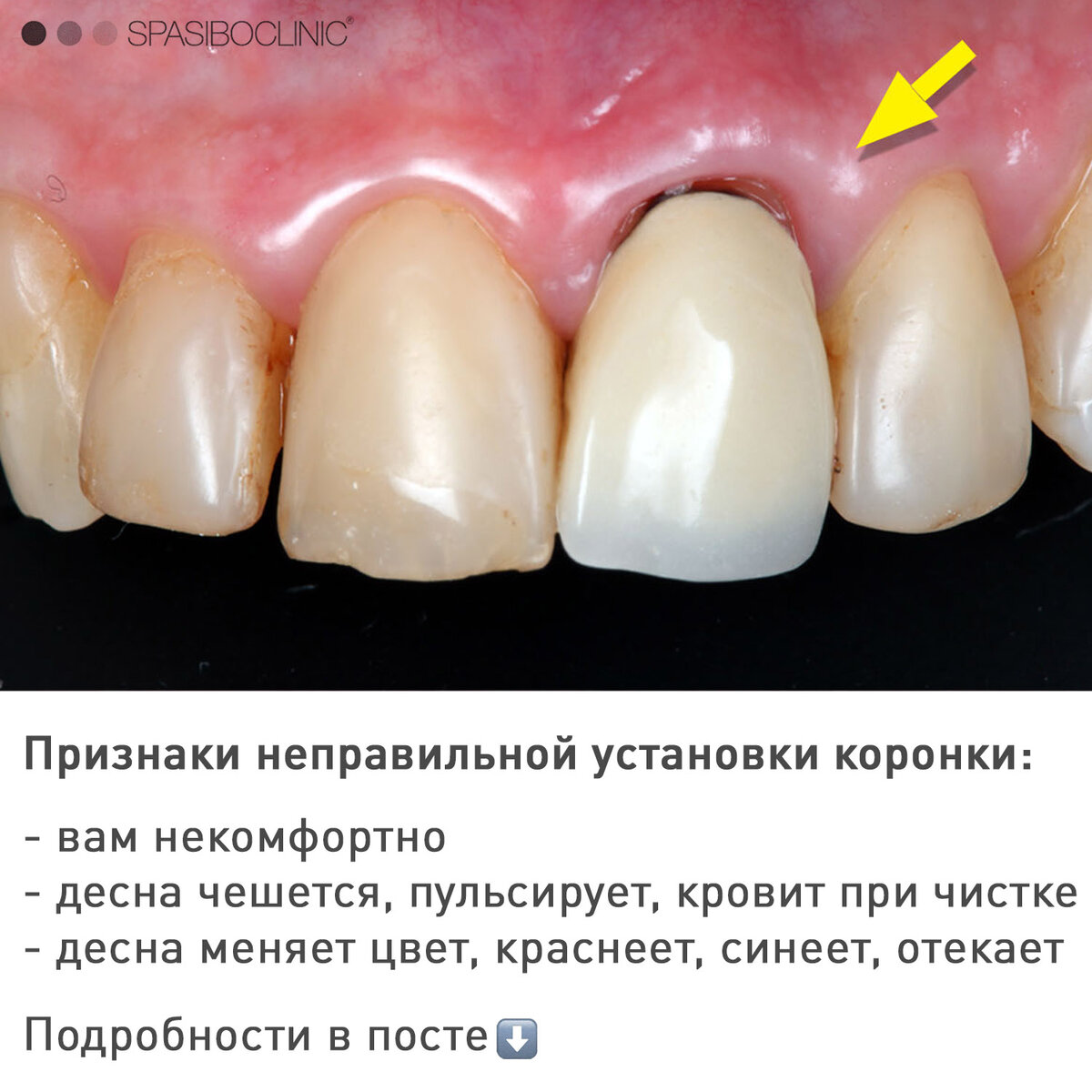 Зубные коронки: врачебные ошибки установки | Стоматология Smile-at-Once | Дзен