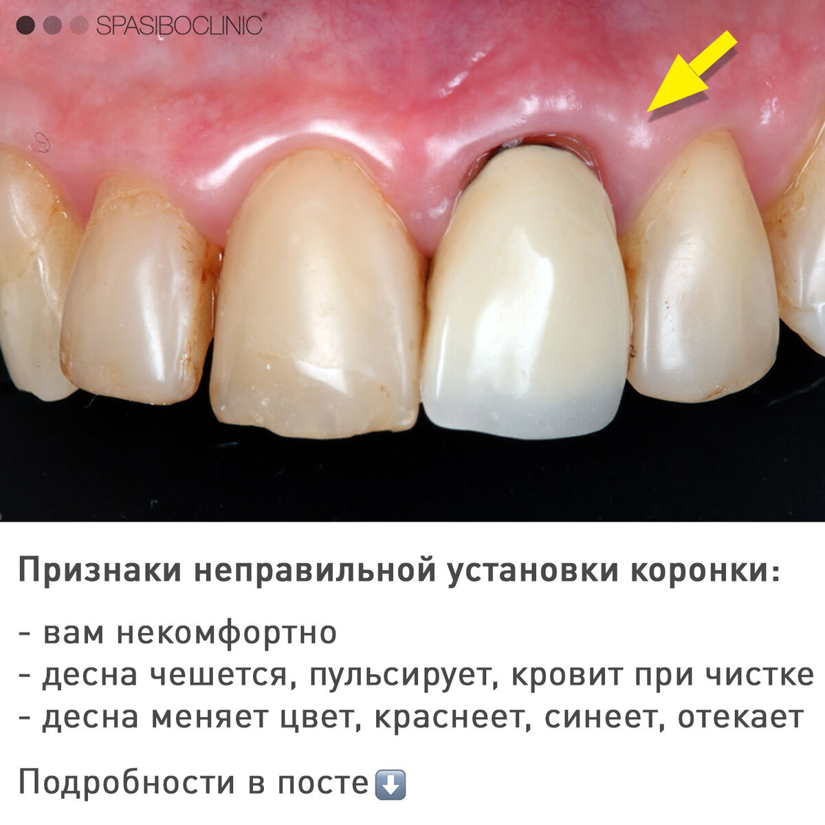 Воспалилась десна около коронки зуба – новости и статьи Refformat