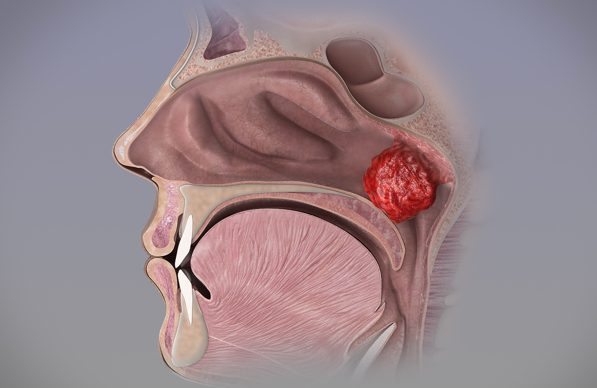 Аденоиды (гипертрофированная глоточная миндалина) в носоглотке.