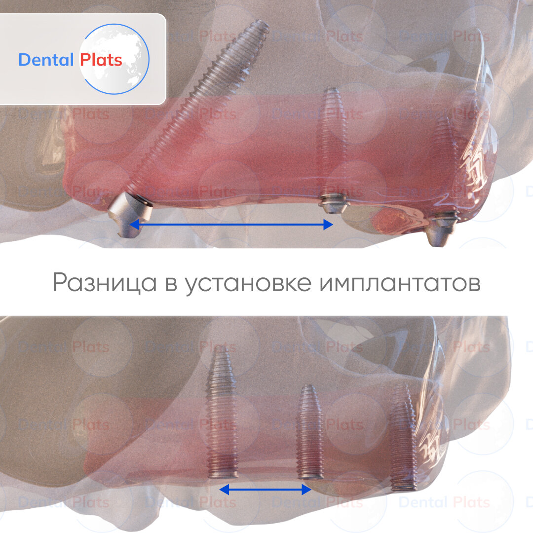 "Зубы за 1 день" методика "Pro Arch" - протезирование з...