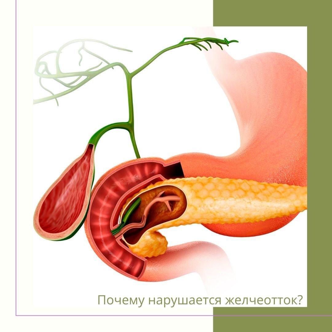 Желчеотток. Желече отток. Почему нарушается желчеотток.