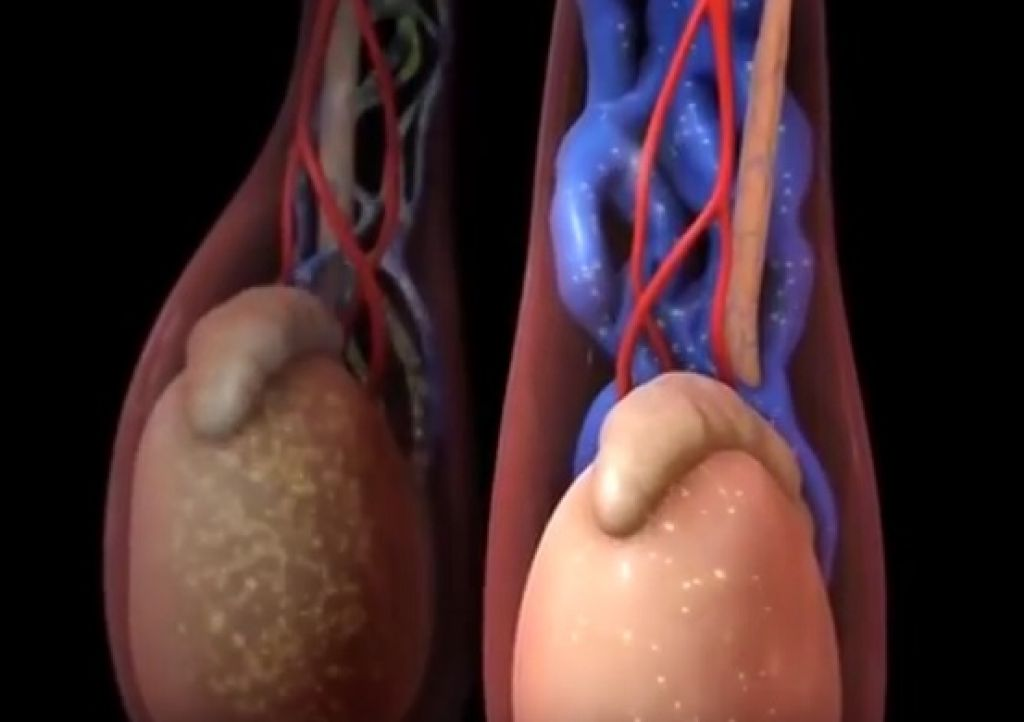 Какие мужские болезни. Варикоз вен семенного канатика. Варикозное расширение вен семенного канатика яичка.. Варикозное расширение вен семенного канатика III степени. Варикозное расширение вен машонка.