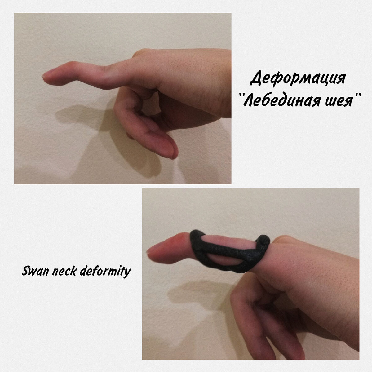 Ортез выполнен из термопластика