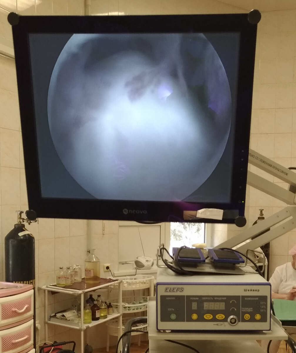 Вид полости голеностопного сустава: виден блок таранной кости