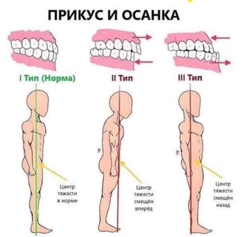 Прикусы и осанка.