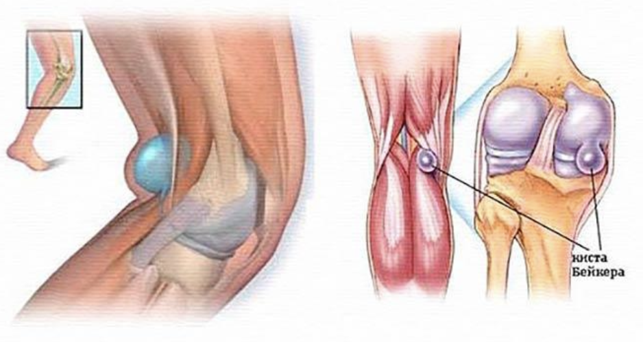 Киста бейкера коленного сустава что