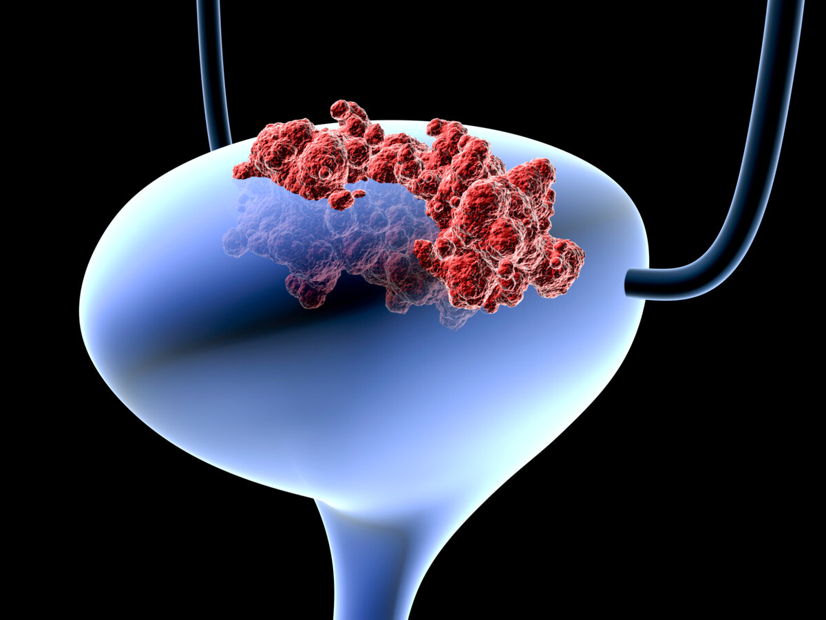 Рак мочевого пузыря психосоматика. Опухоль карцинома мочевого пузыря. Паллиативная цистэктомия. Опухоли мочевыделительной системы.