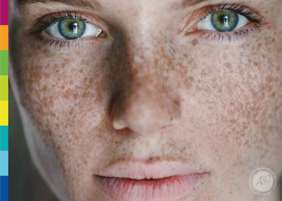 Милые веснушки или уже пятна?