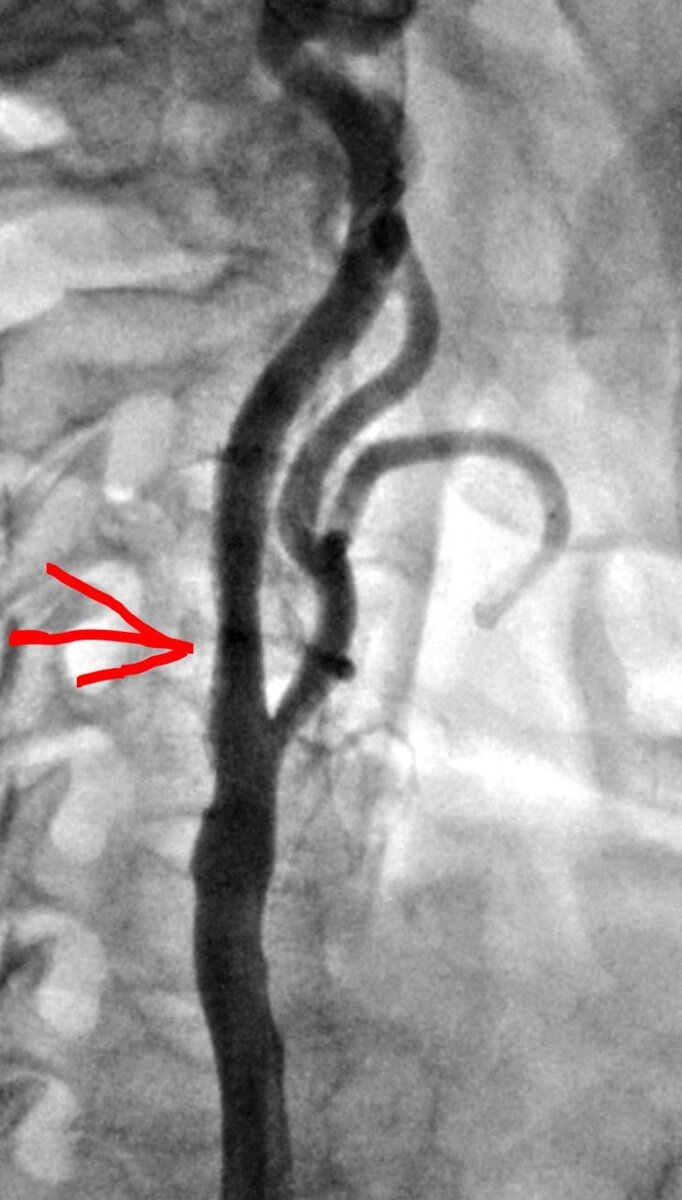 Окклюзия сонной артерии. Стентирование сонной артерии. Стентирование сонной артерии на УЗИ.