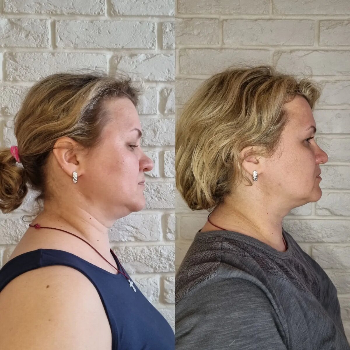 фото слева ДО: шея укорочена, имеются кольца Венеры, много лишней кожи, отечность.  Слева ПОСЛЕ: подтянутая и удлинённая шея, кольца Венеры не заметны