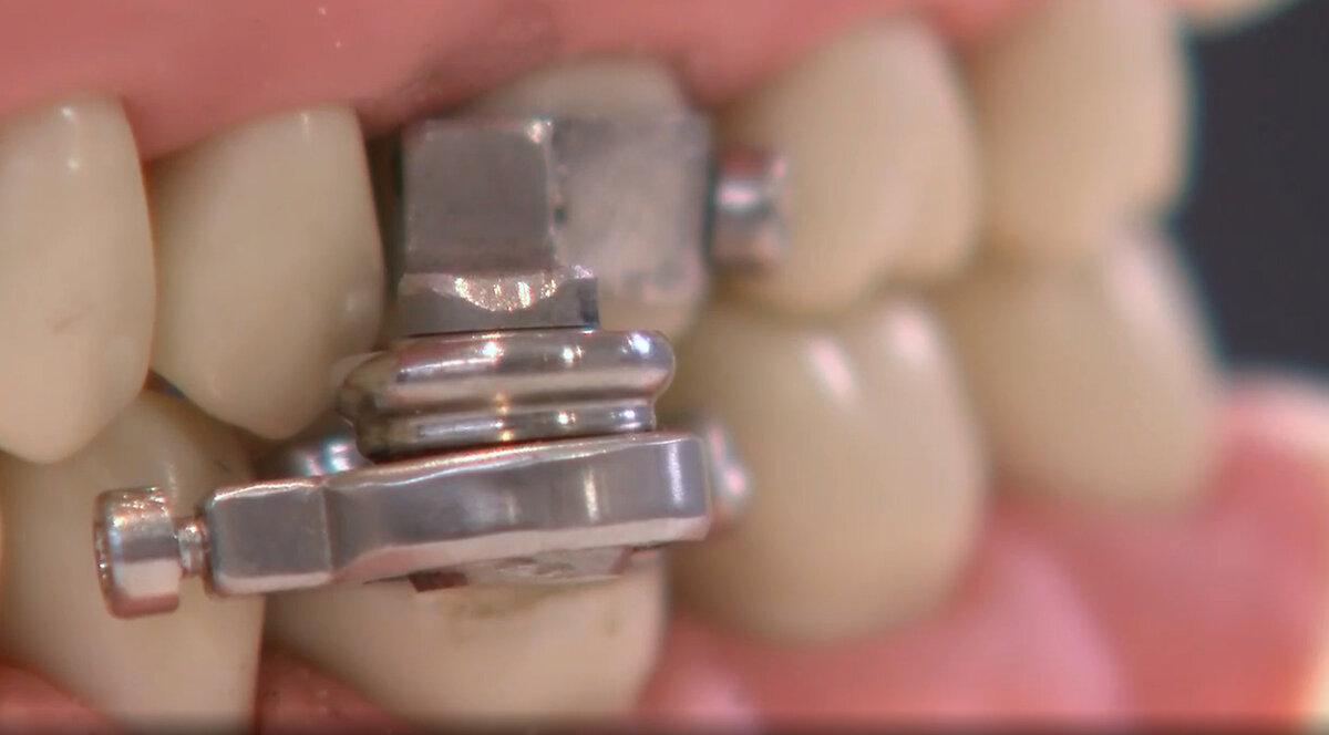 Dental Slim Diet Control создаёт расстояние между зубами в 2 миллиметра