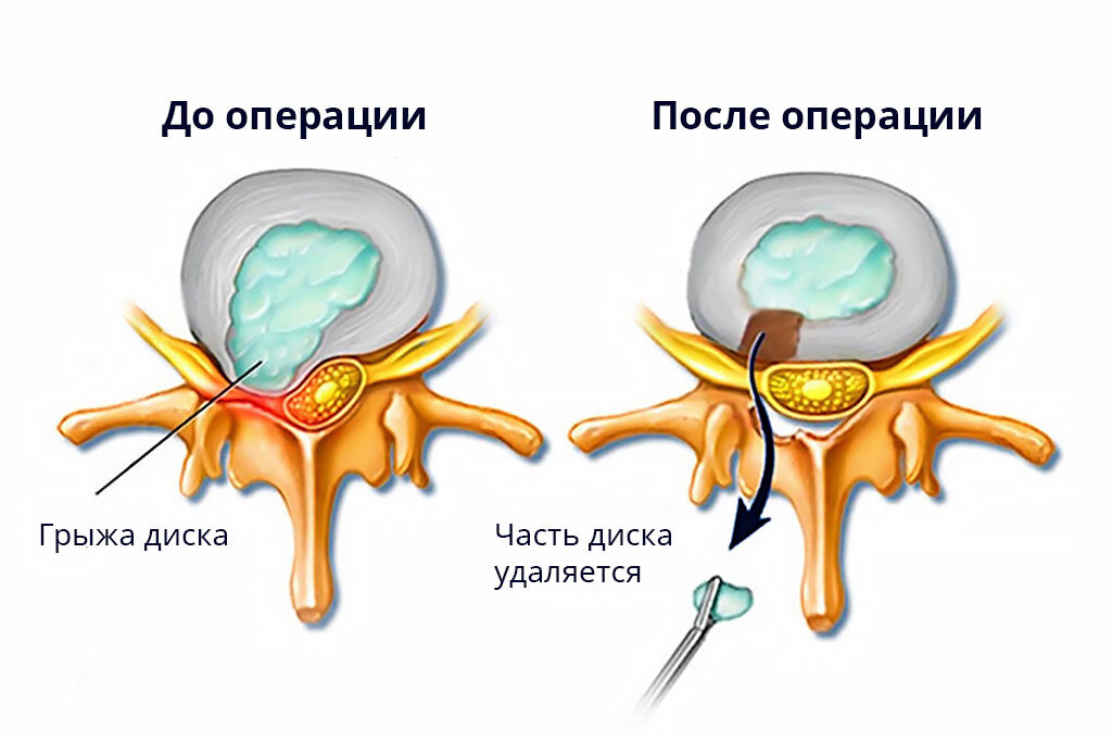 Дискэктомия поясничного отдела позвоночника схема операции