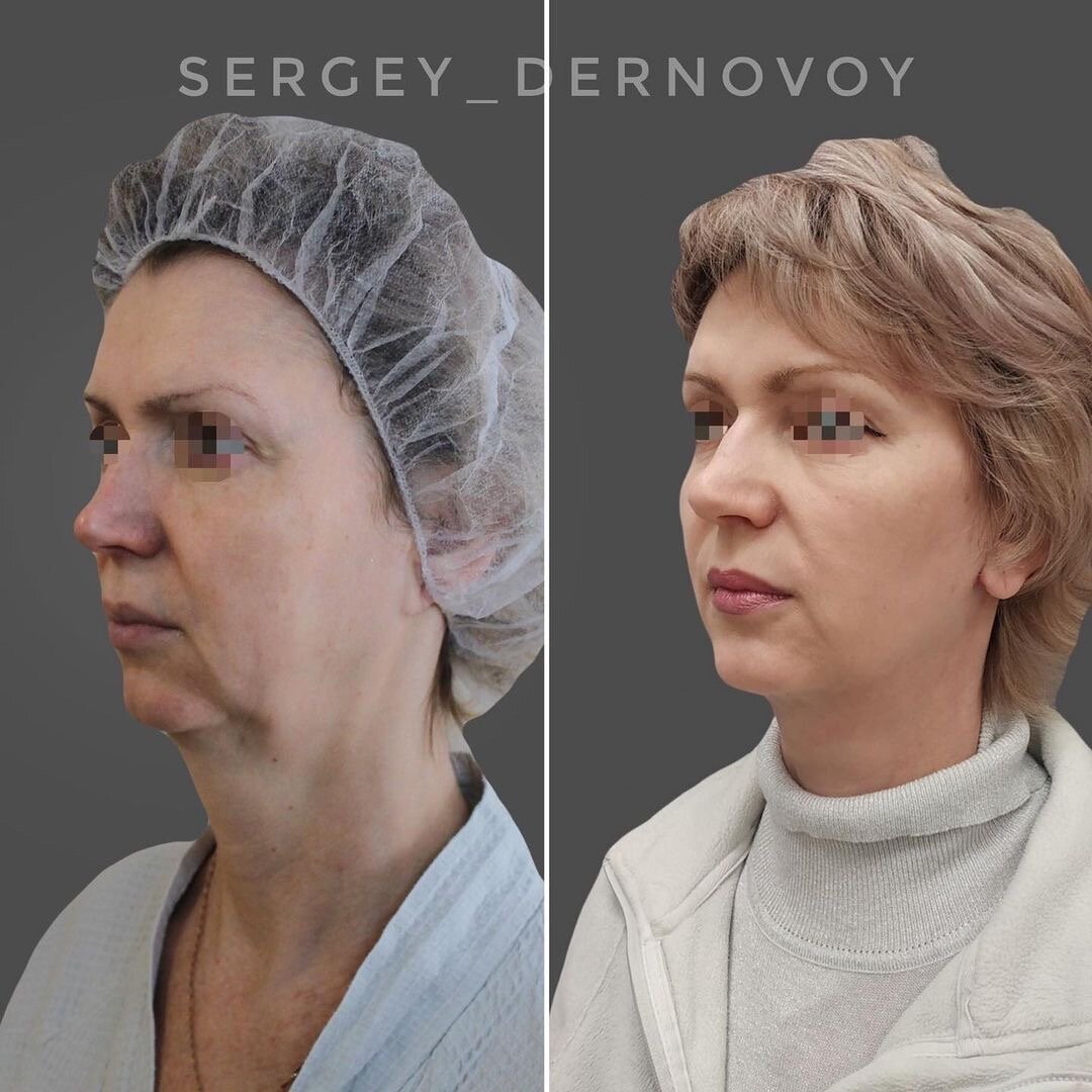 Латеральная платизмопластика