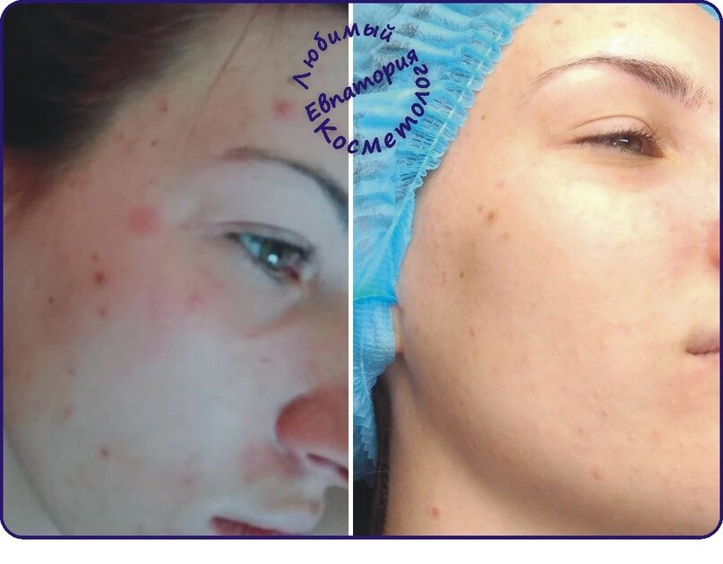 на фото моя пациентка проходила лечение