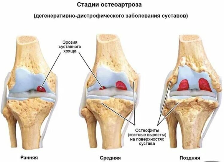 Стадии остеоартроза