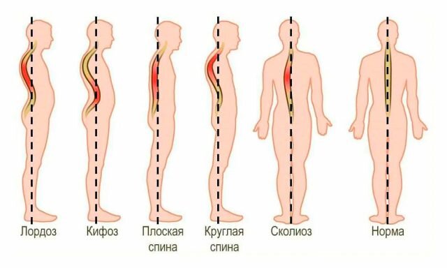 Разные стадии искривления позвоночника