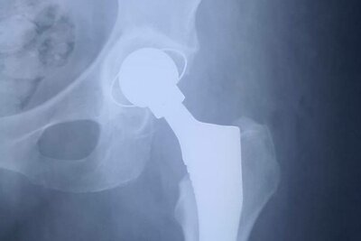    Рентгеновский снимок жительницы Луховиц после эндопротезирования тазобедренных суставов © Сайт Министерства здравоохранения Московской области