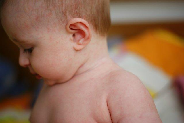 Чем лечить сыпь на теле у ребенка
