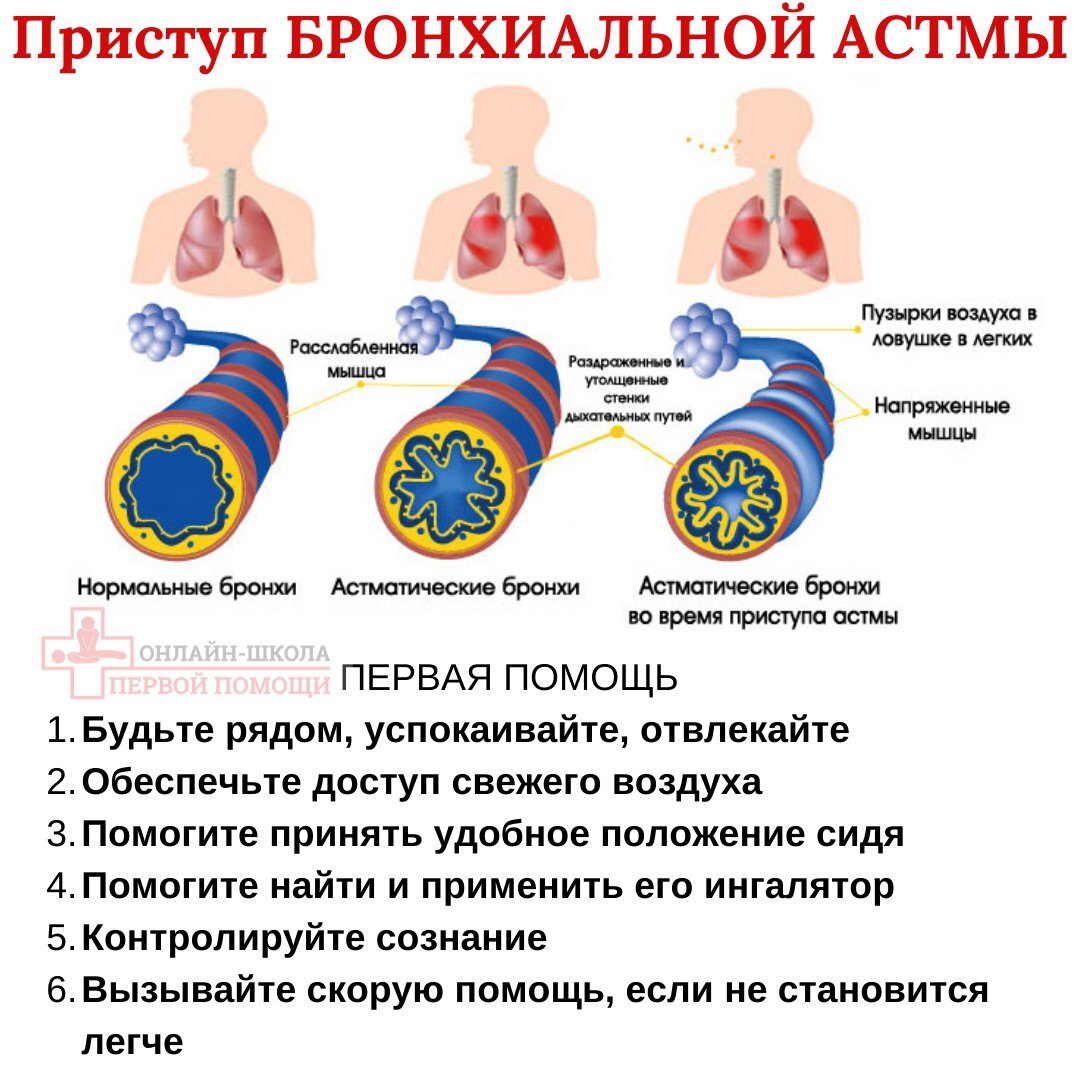 Бронхиальная астма: симптомы, диагностика и лечение | Медицинский дом Odrex