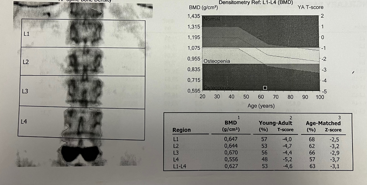 Денситометрия поясничного отдела позвоночника. Т-критерий равен -4.6, что соответствует тяжелому остеопорозу.