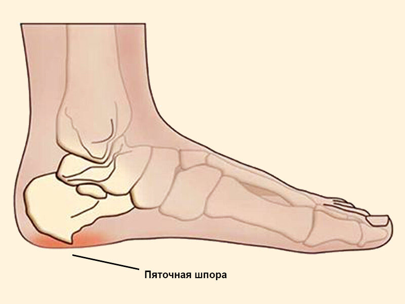 Лечение пяточной шпоры: методы и рекомендации