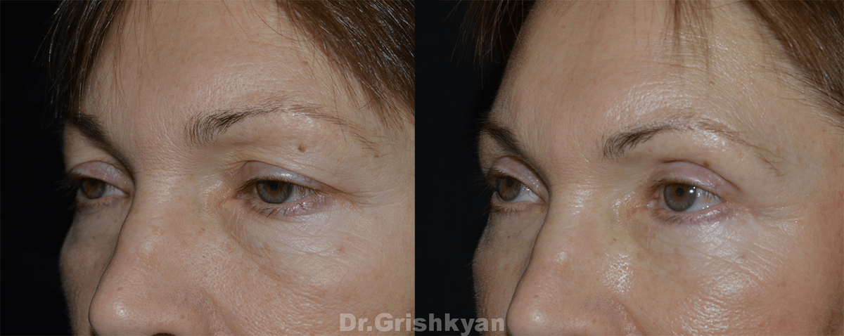 Миф 2: Блефаропластика всегда приводит к изменению формы глаза