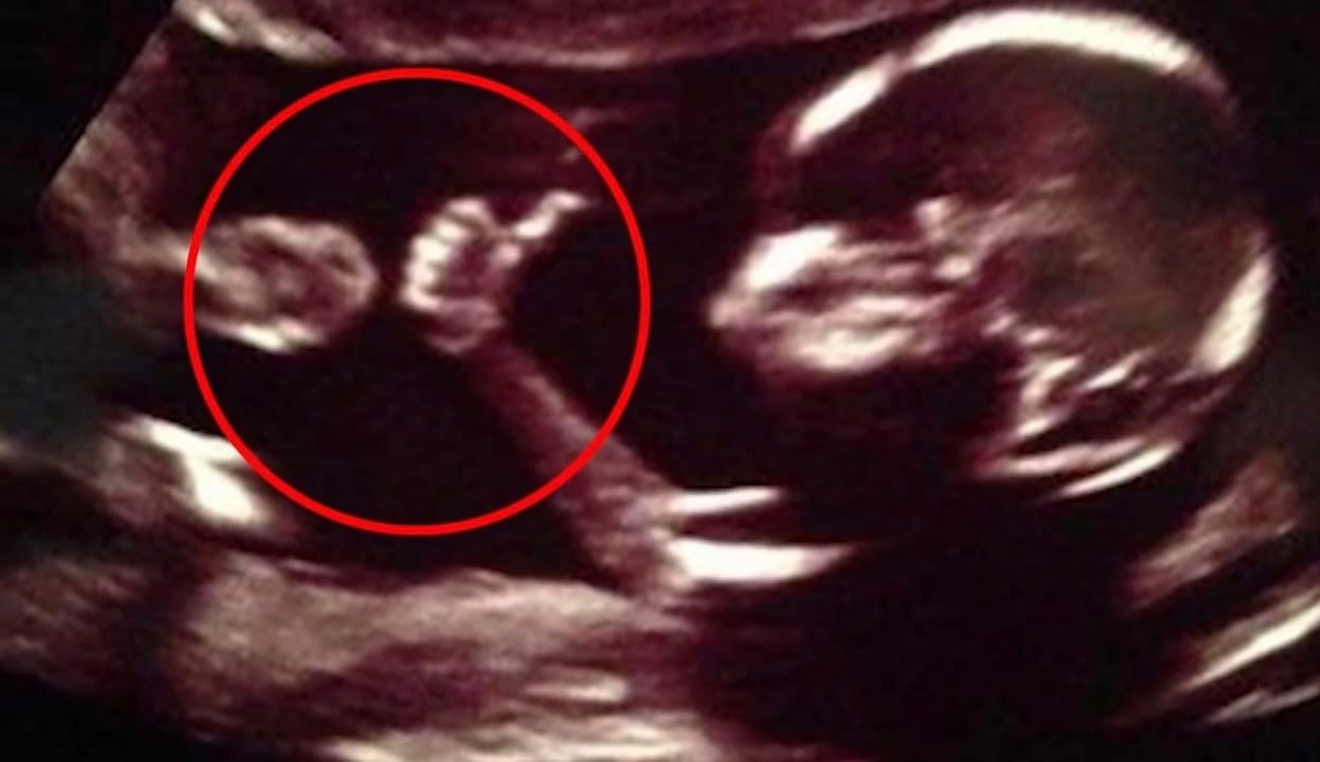 10 детей, которые делали странные вещи во время УЗИ! | Профессор Гуглов ...