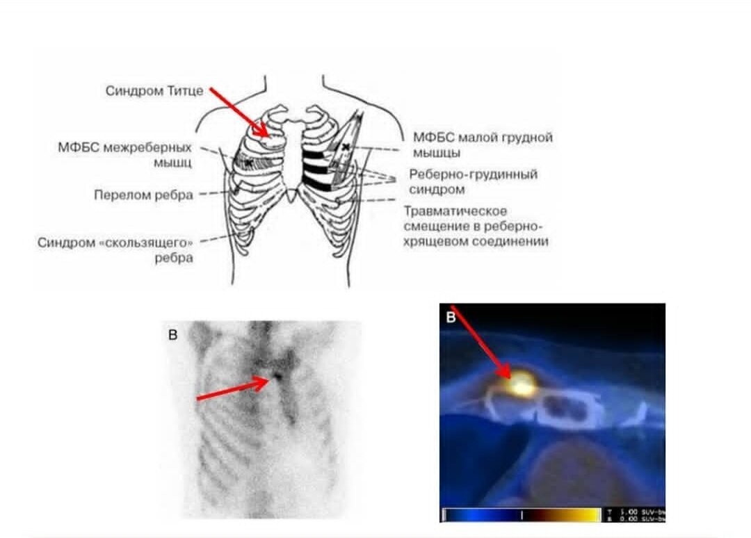 Титце синдром у детей фото