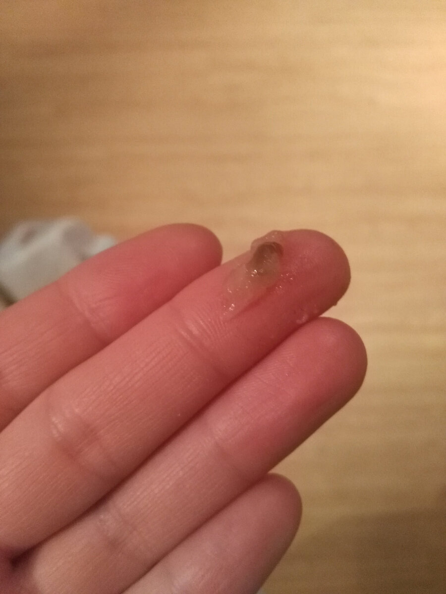 Светлые выделения с примесем сгустка крови