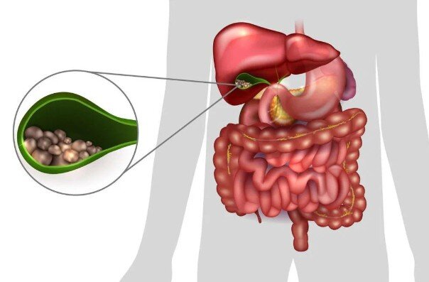 Камни в желчном пузыре