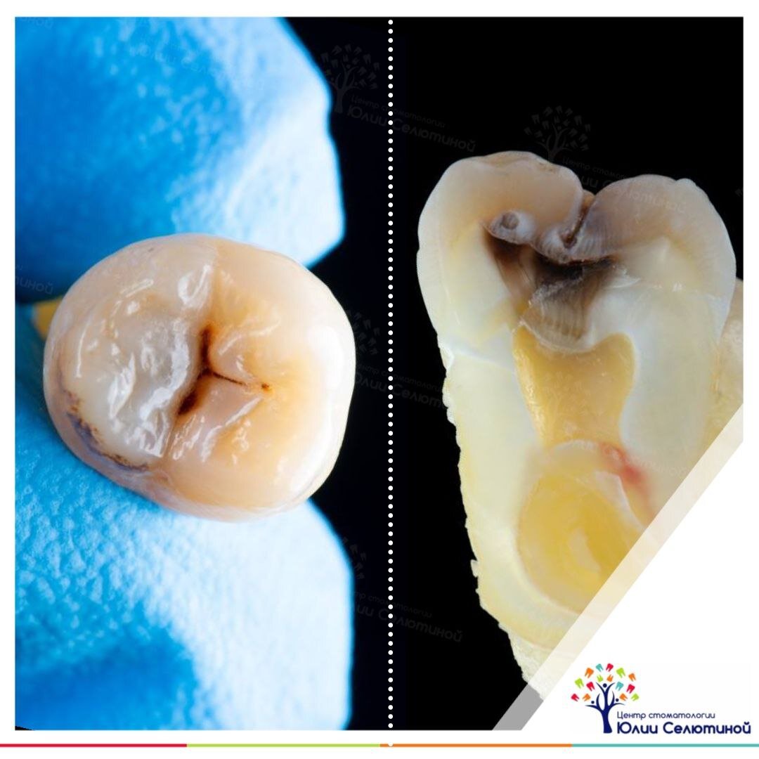 Маленькая темная точка на зубе может означать большую кариозную полость! |  Юлия Селютина | Дзен