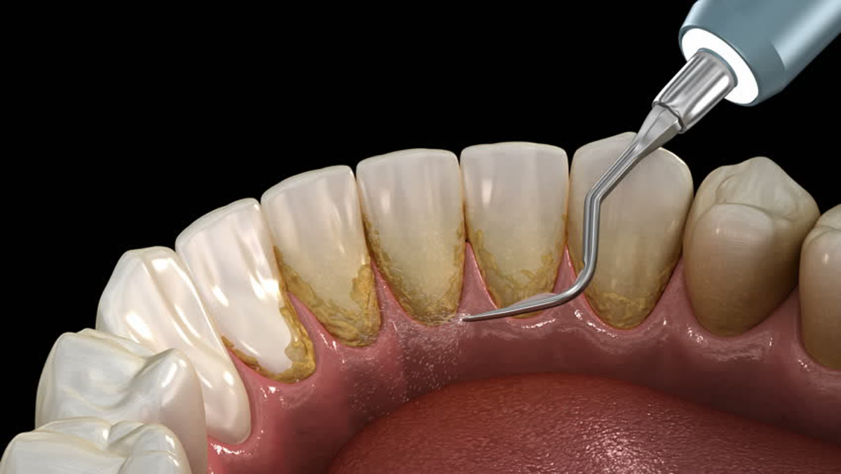 Удаление налета. Поддесневые отложения зубной камень. Зубной камень ультразвуком. Поддесневой зубной камень. Ультразвуковая профгигиена.