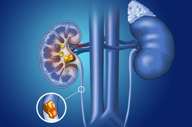    Чем опасны камни в почках и как их предупредить?