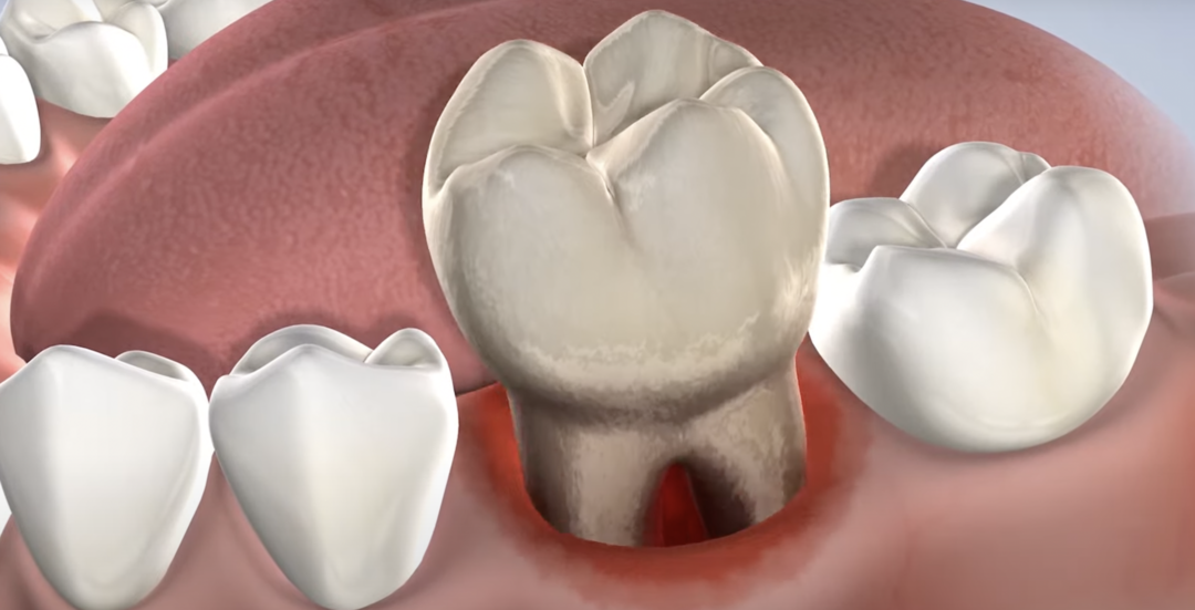 Удаление жевательного моляра. Анимация автора.