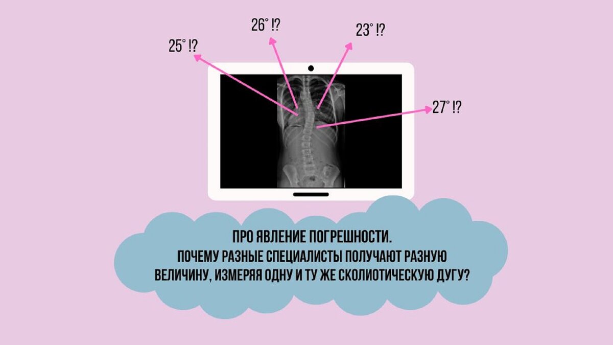 Почему разные специалисты получают разную величину, измеряя одну и ту же сколиотическую дугу?