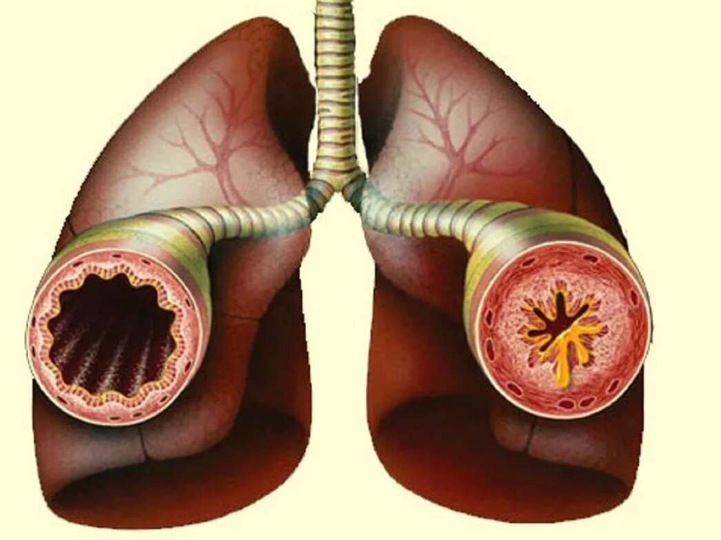 Астма фото бронхов