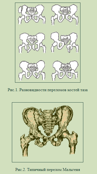 Факторы риска