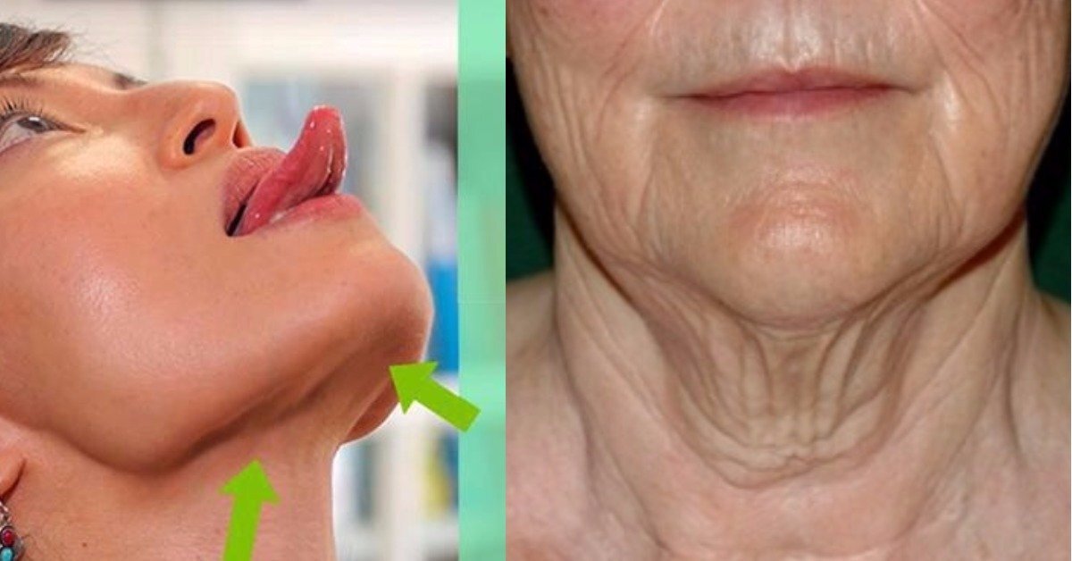 Подтяжка подбородка. Платизмопластика нити аптос. Платизмопластика нити аптос. Как подтянуть кожу на шее. Липолитик в подбородок до и после.