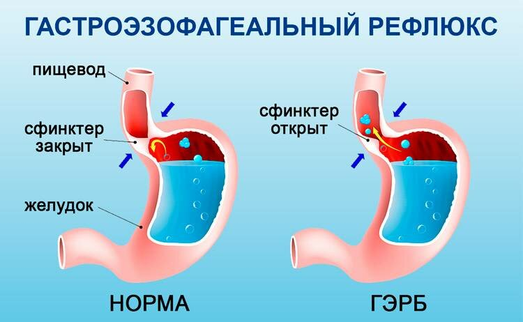 Гастроэзофагеальный рефлюкс