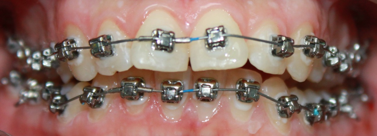 Самолигирующие брекеты
