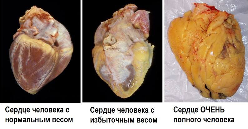 Ковид вызывает воспаление в жировой ткани человека  Еще в начале эпидемии коронавируса много говорилось о том, что люди с ожирением в группе риска.-2