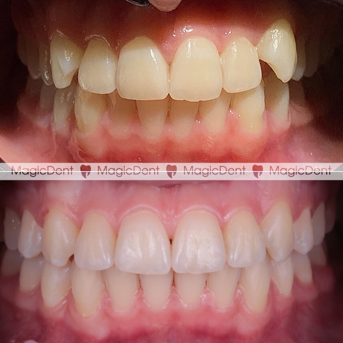 Результат лечения на брекет-системе за 1 год и 4 месяца | Стоматологические  клиники MAGIC DENT г. Сочи | Дзен