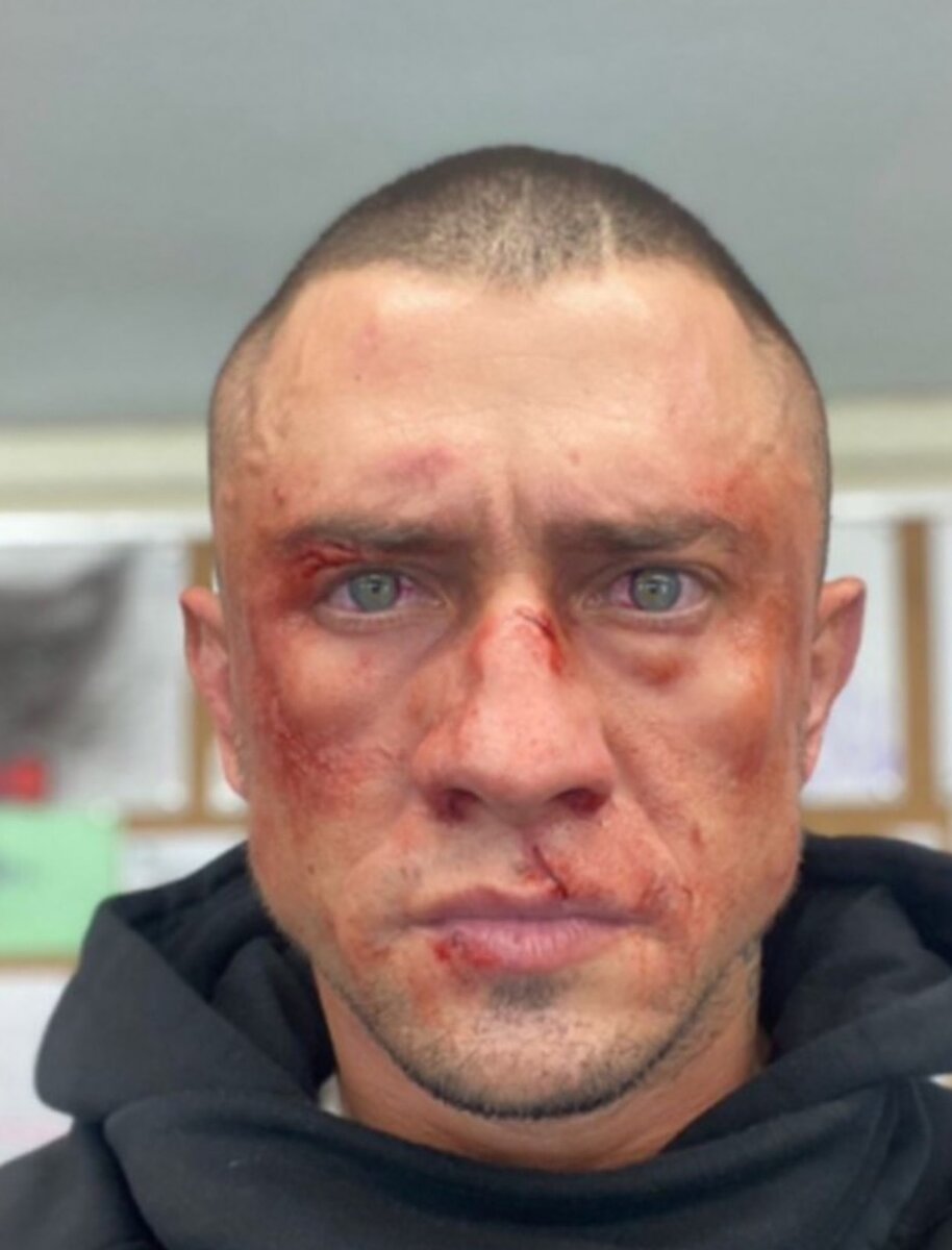    Павел Прилучный после инцидента в Калининграде Фото: Инстаграм (запрещен в РФ)