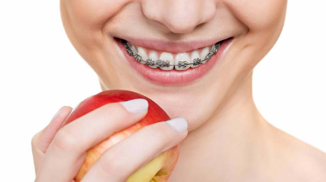 Уход за брекетами