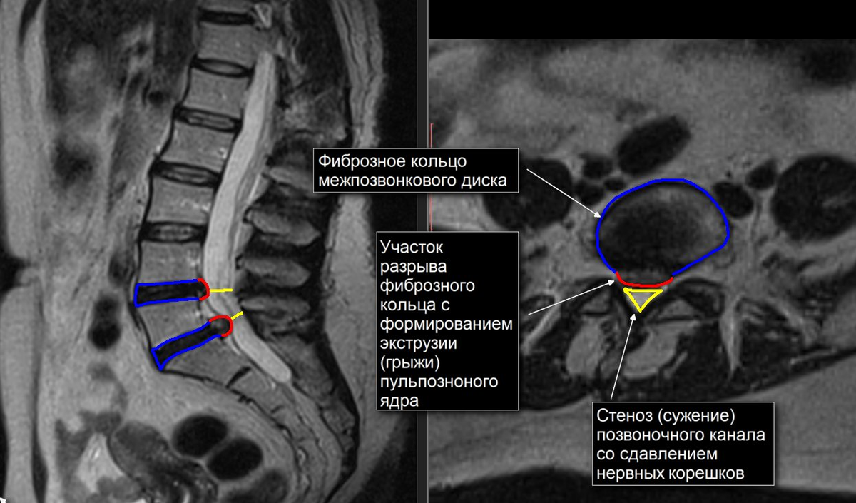 Грыжа диска картинки